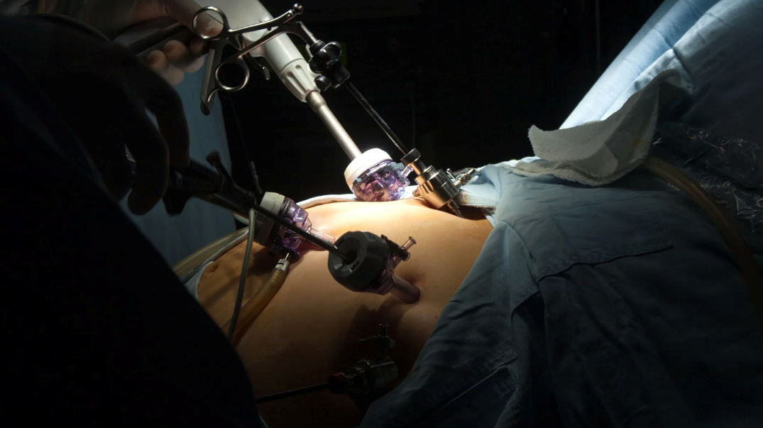 Psychological Benefits of Gastric Bypass Surgery